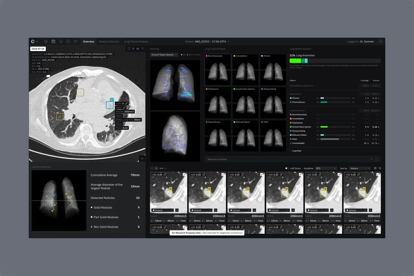 CT viewer with lung scans and a list of nodule findings